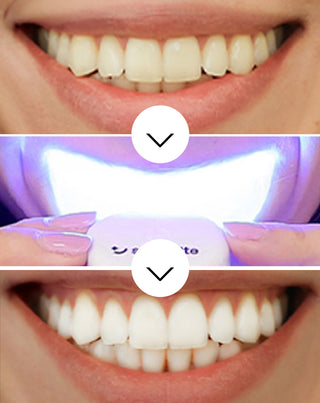 Smilebite Light & Bright Teeth Whitening Kit LED Lamp + Whitesmile Serum™ - 3